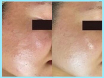 ハーブピーリング 名古屋/TETEピール導入★