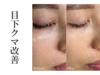 エトレ(etre)/クマ/くすみ/目元/アイケア