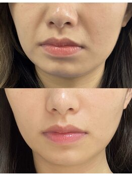 ユミサロン(U Mi Salon)の写真/ほうれい線が気になる方へ
内側から潤いをチャージして
ふっくらハリ肌へ
