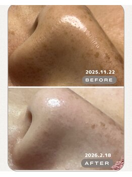 毛穴屋 京都/くすみ知らずの素肌へ。