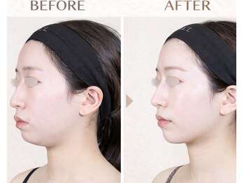 ココリラ(cocorira)の写真/《人気No. 1》小顔リフトスペシャル　5,800円レッドショットとEMS×RFでスッキリ小顔♪ダウンタイムなし♪