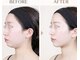 ココリラ(cocorira)の写真/《人気No. 1》小顔リフトスペシャル　5,800円レッドショットとEMS×RFでスッキリ小顔♪ダウンタイムなし♪