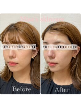 ミサズ スキンケア(misa's skin care)/ビフォー/アフター 20代