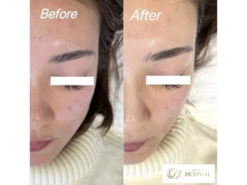 サロン ド デンファレ(salon de denphal)/ハイドラフェイシャル～小顔～