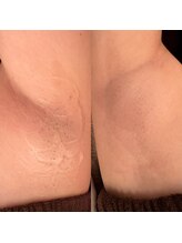 マハロ(MAHALO)/両ワキ脱毛￥1100