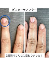 桃の木 吉祥寺店/夏は爪が早く伸びます♪