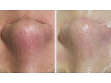 クレアス 勝どき(CREAS)/20代女性　毛穴の汚れ・毛穴開き