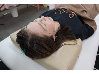 ことぶき整骨院/美容鍼50分コース