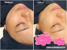 オプス ライフビューティー(OPS×LIFE BEAUTY)/小顔になりたい☆