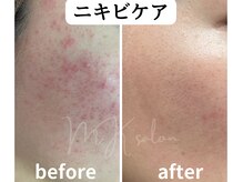 エムケーサロン(MK salon)の雰囲気（ハーブピーリングで肌質改善。顔、腕、背中など全身できます♪）