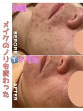 パルティノ 高崎店/悩みのニキビケア七か月