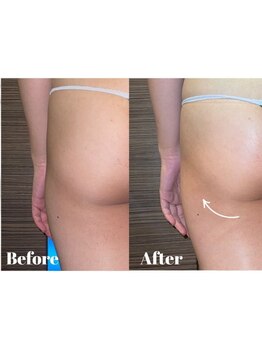 太モモ・ヒップまわりをケアしたい