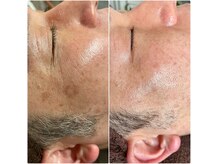 最新光フェイシャルでシミケア。フェイシャルはメンズもOKです！