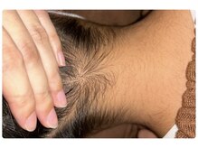 ベルフィオーレ(bel fiore)/10代女性　初回 Before