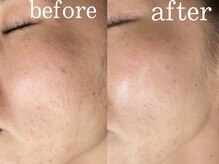 アシャ(ASHA)/翠ハーブピーリング