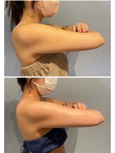 ルナグランデ(Luna grande.)/背中側の腕のお肉がスッキリ♪