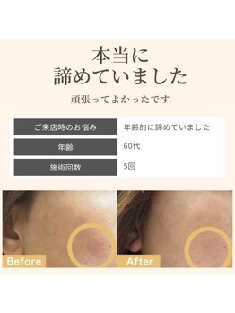 毛穴専科/まだ諦めるには早い!シミケア