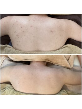 ビビッシュアール(bibiche R)/ハーブピーリング