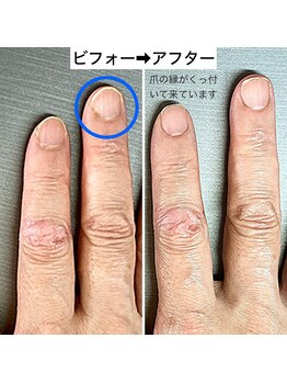 夏は自爪育成しやすい季節