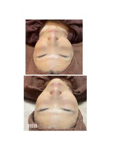 ヴィヴィエ 佐賀店(ViVier)/ララピール　症例　1回