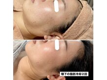 ルーチェエムベルシック(Luce.MBelChic)の雰囲気（顎下の脂肪冷却2回★小顔効果あり◎）