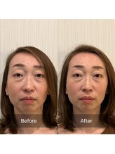 ナギ鍼灸院(nagi鍼灸院)/むくみ・たるみ改善美容鍼　1回