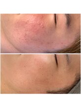 サロンメロウ 大牟田店(salon mellow)/【韓国美容No,1】ララピール