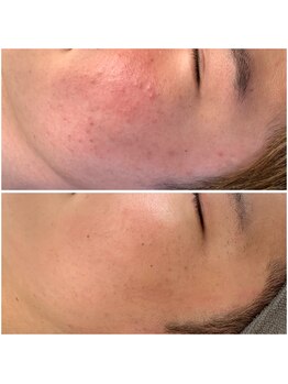 サロンメロウ 大牟田店(salon mellow)/【韓国美容No,1】ララピール