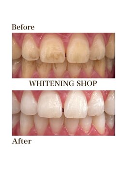 ホワイトニングショップ 岸和田店/お客様のBefore  After