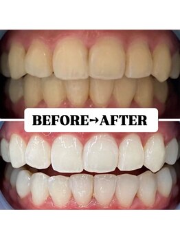 ホワイトニングサロン 豊中/Before&After美白ホワイトニング