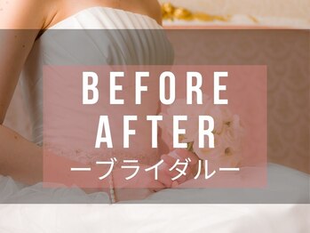 メディカルエステサロン ローズ 金沢本店(ROSE)/ブライダルビフォーアフター