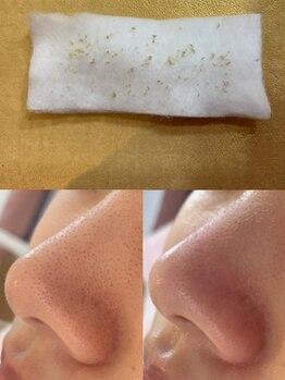 サロンこころ/1回でこの効果！毛穴ケア