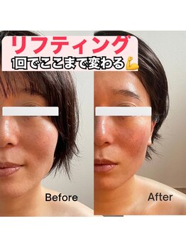 ママニエ(ma maniere)/小顔ほうれい線にリフトアップ