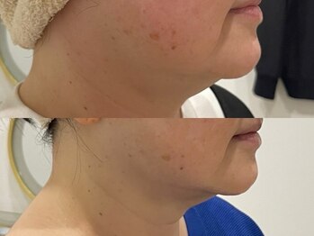 エミュ(emu)/レモンボトル3回でこの変化!