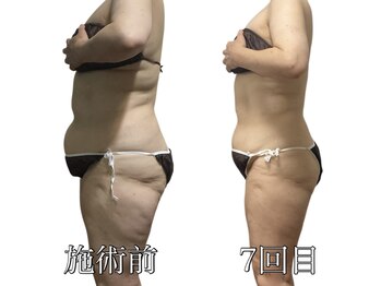 エリクシア 松戸/50代全身痩身7回目(お腹と太もも