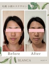 ブランカ(BLANCA)/小顔セラピアビフォーアフター