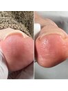【巻き爪ケア】1回での施術☆