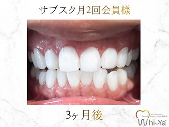 ホワイヤ セルフホワイトニング DBS神楽坂(Whi-Ya)/☆サブスク会員様☆納得の白さ☆