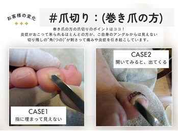 テネシー/#爪切り:巻き爪の方