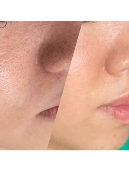 お顔そりローズマリー/ハーブピーリング