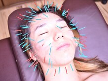 鍼屋フミ(鍼屋FUMI)/140本超の美容鍼