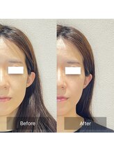 ウル(ulu)/エラの張りがかなり変わりました