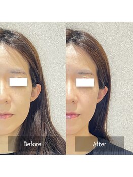 ウル(ulu)/エラの張りがかなり変わりました