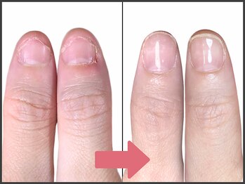 アモ 坂戸(’Amo)/深爪矯正・自爪育成 坂戸/北坂戸