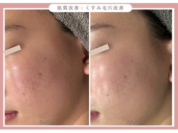 グレースエール トータルビューティーサロン(Grace Aile)/肌質改善