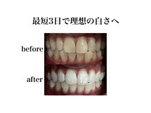 エル(L)の雰囲気（平均3～5回のご来店で理想の白さを実感）