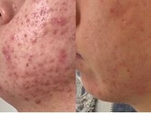 ベラーモ(BELLAMO)/【肌質改善】