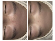 シロ(CHILO)/プラズマシャワーでニキビ改善