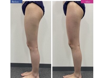 インナーメス(INNER MES)/むくみで厚みが変わる!