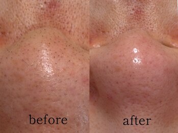 ウィズルーチェ 神栖店(with luce)/毛穴洗浄１回効果★鼻黒ずみ毛穴